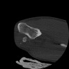 SPORK, NICO - 22.03.1976 - 02.08.2022 - CT obere Extremität - 17:51:17